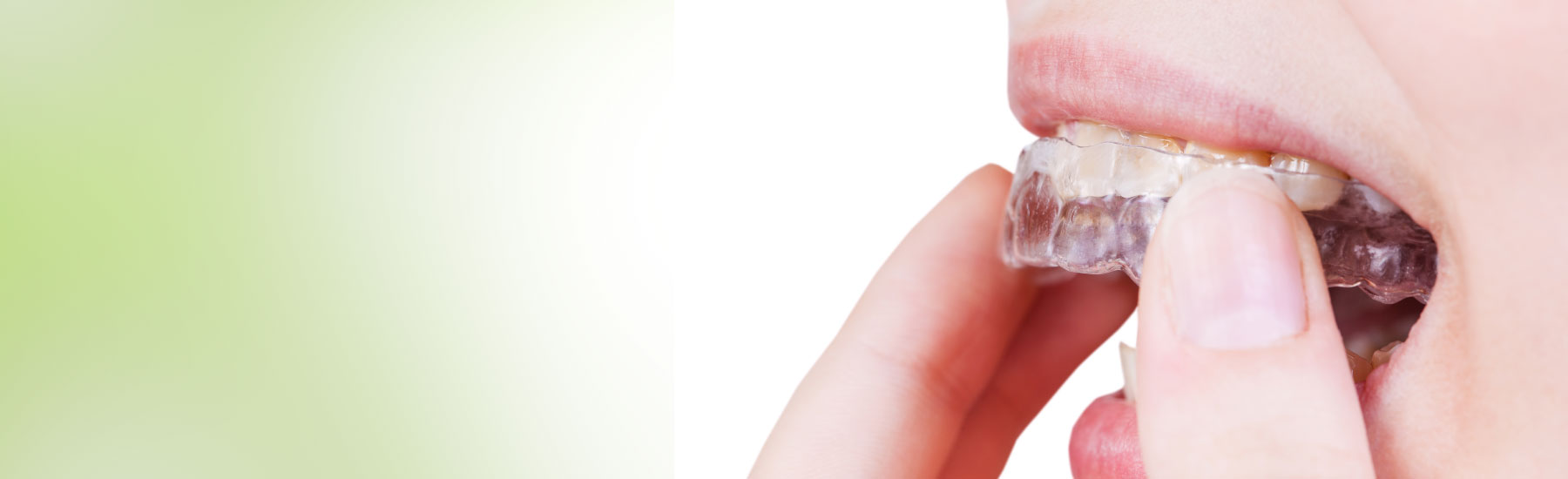 Professional Mouth Guards